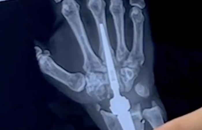 Bari, se implanta la primera prótesis de muñeca en todo el Sur: “Ahora el paciente mueve la extremidad y ya no siente dolor”
