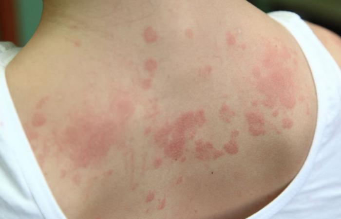 ¿Cuáles son los primeros síntomas de una alergia?