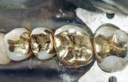 Detuvieron a ladrones con 268 dientes empastados de oro en un coche