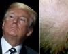 Caída del cabello, la droga utilizada por Trump puede provocar disfunción sexual y trastornos psiquiátricos