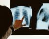 Tuberculosis, llamado urgente a las instituciones para mejorar el acceso al tratamiento