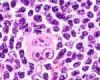 Linfoma de células del manto. Acalabrutinib más quimioinmunoterapia de primera línea reduce el riesgo de progresión de la enfermedad o muerte en un 27%